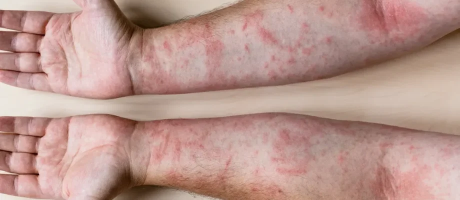 4 Potential Reasons For Your Rash
